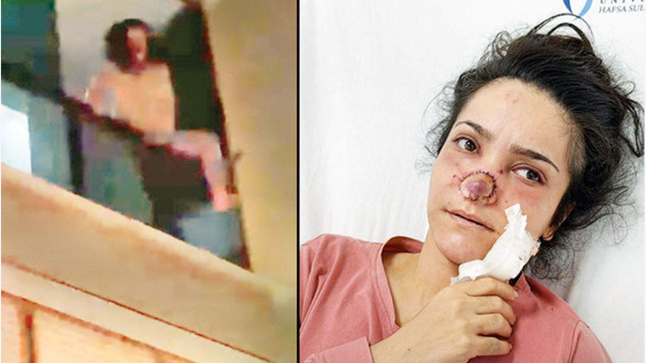 Burnu ısırılıp koparılan İmran: Acıdan atlamayı düşündüm